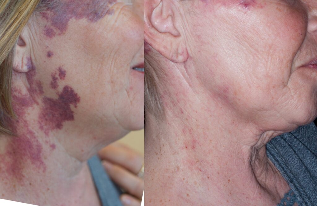 Pre e post trattamento laser angioma viso e collo - Dott. Davide Brunelli