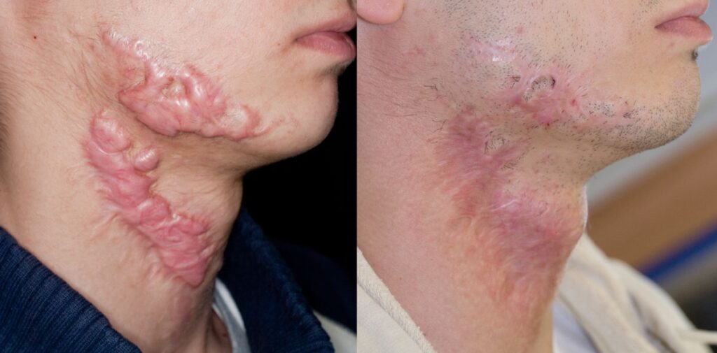 Prima e dopo trattamento laser cheloidi - Dr. Brunelli Davide