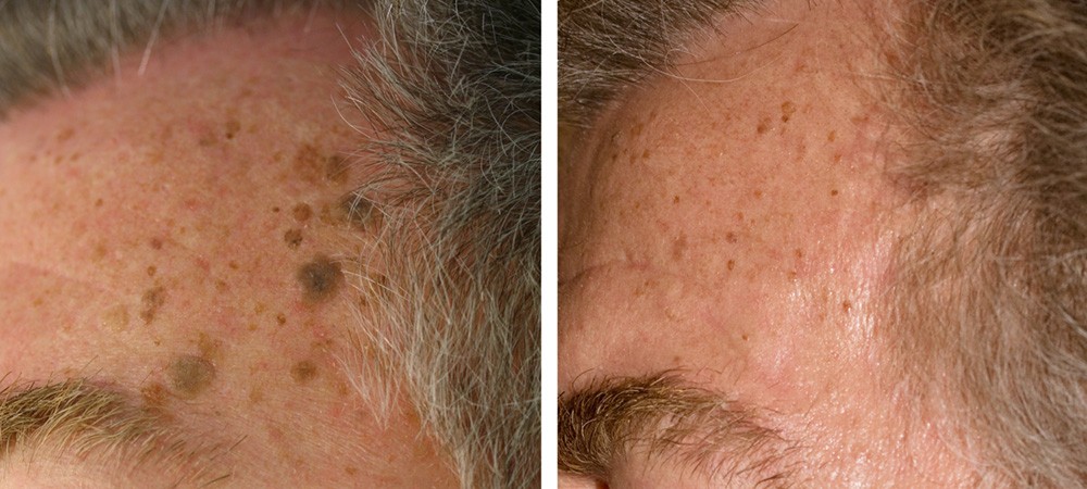 Prima e dopo trattamento laser cheratosi seborroica - Dr. Brunelli Davide