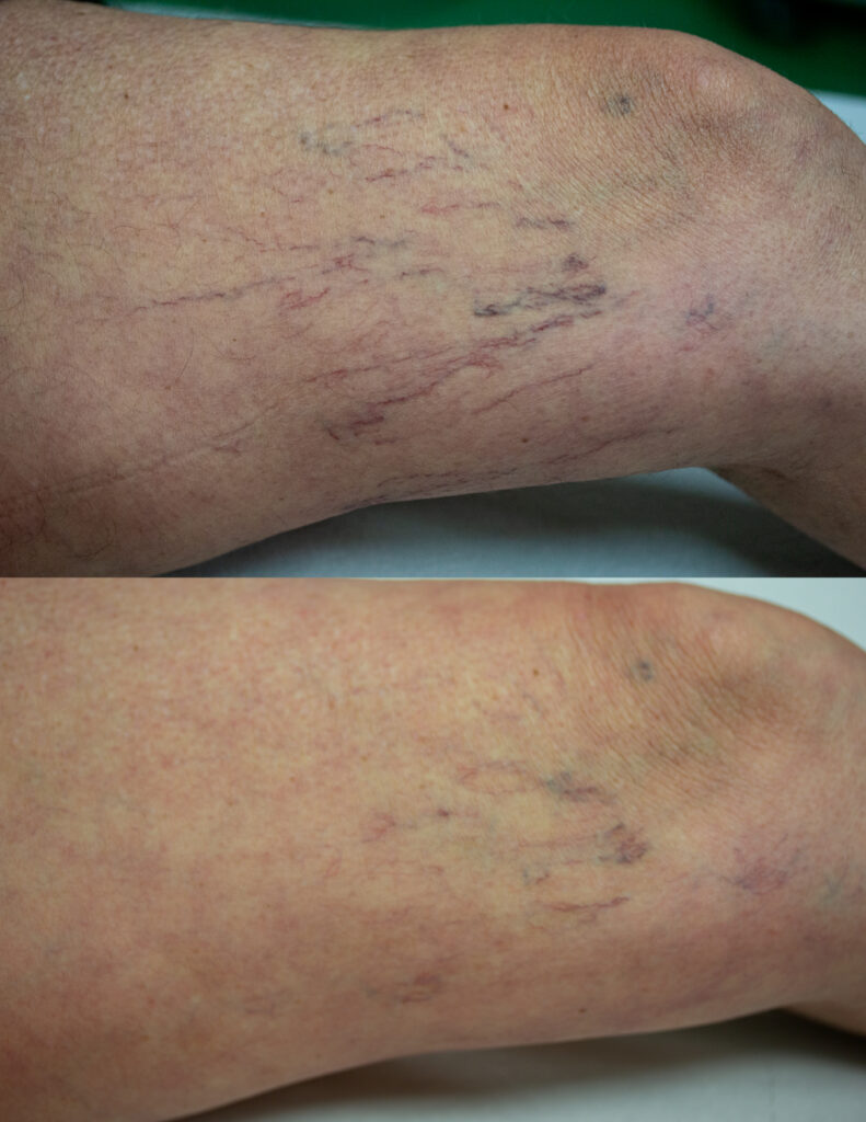 Teleangectasie blu gambe pre e post laser - Dr. Brunelli Emilia Romagna